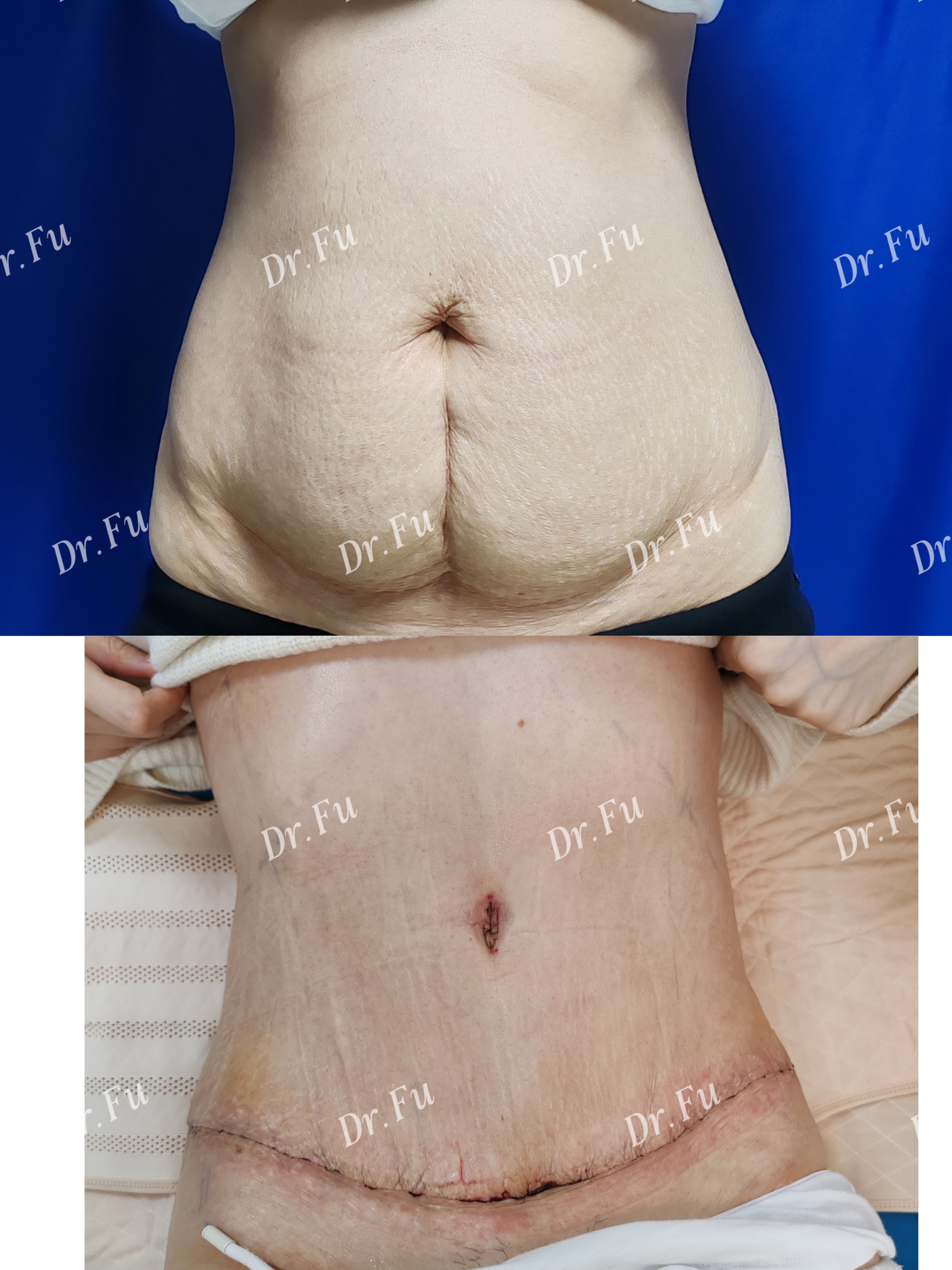 Abdominoplasty Case 9